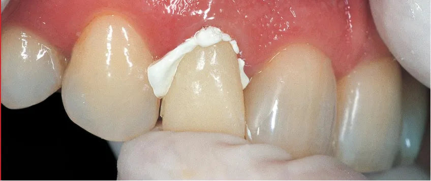 Gc Freegenol 1-1 Pkg