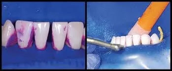 Bioclear Blaster Dual Color Disclosing Solution