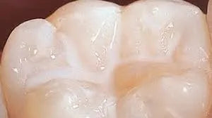 3M ESPE Clinpro Pit & Fissure Sealant