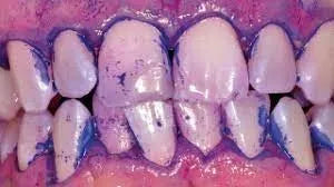 Bioclear Blaster Dual Color Disclosing Solution